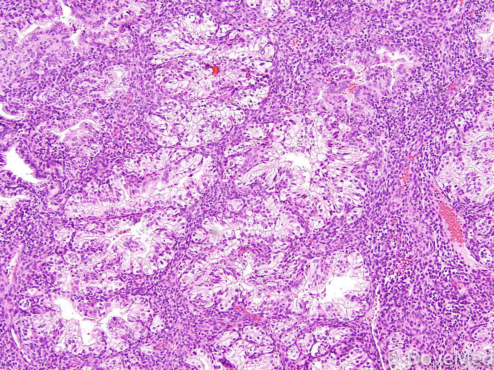 clear-cell-carcinoma-of-endometrium