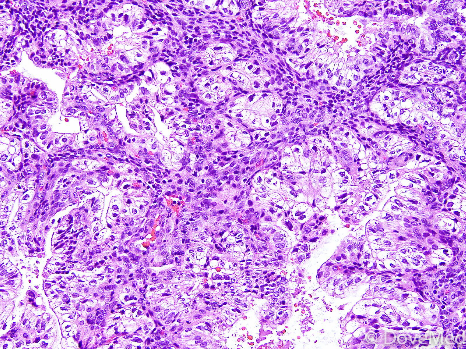 glycogen-rich-clear-cell-carcinoma-of-breast