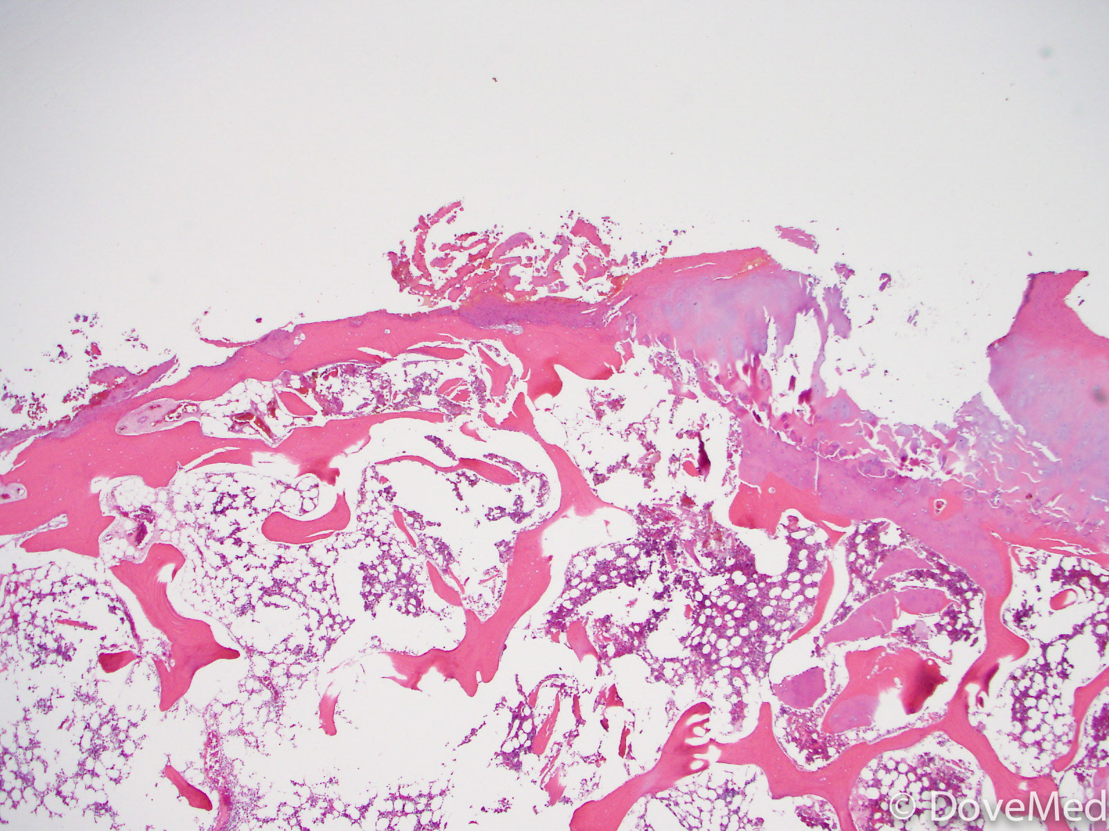 Acute Osteomyelitis