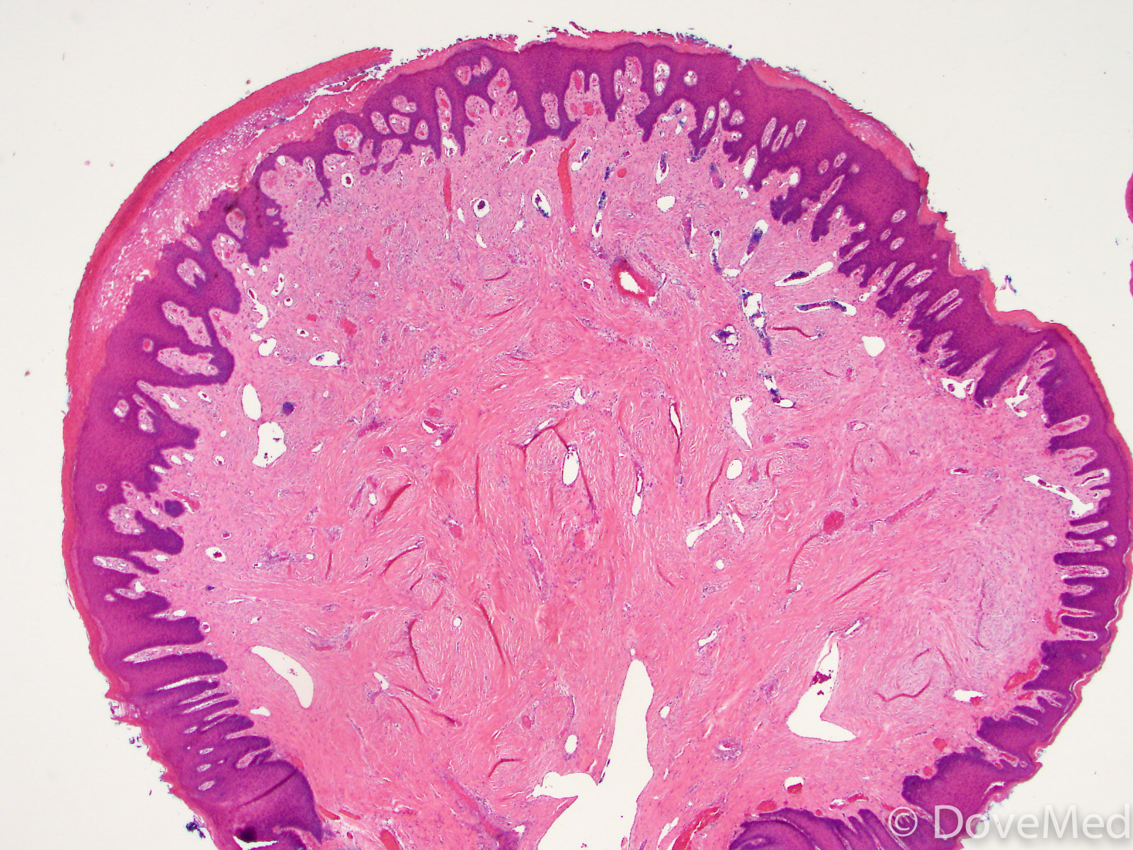 irritation fibroma histology