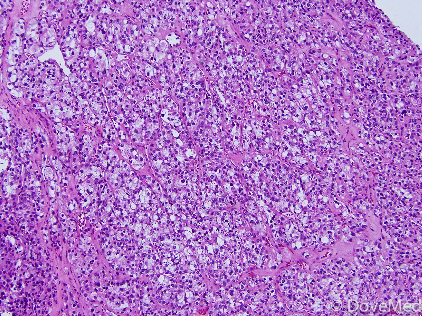 clear-cell-carcinoma-of-cervix