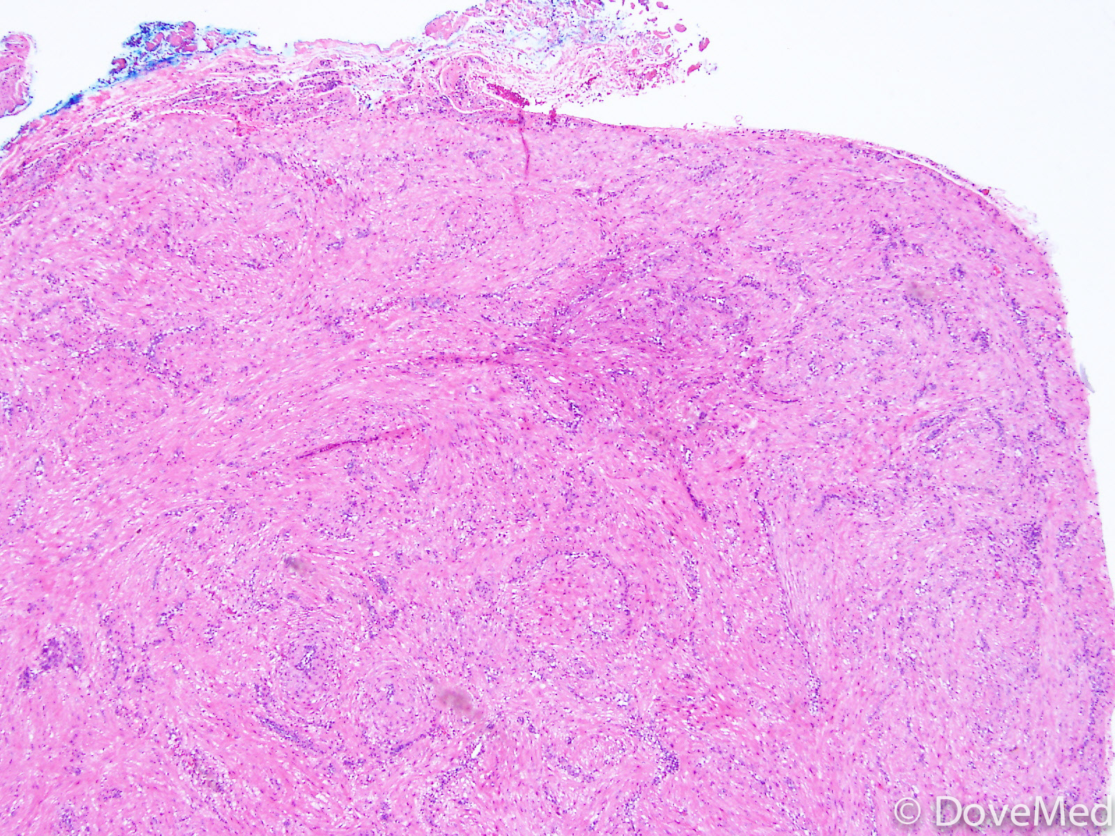 Leiomyoma of Colon