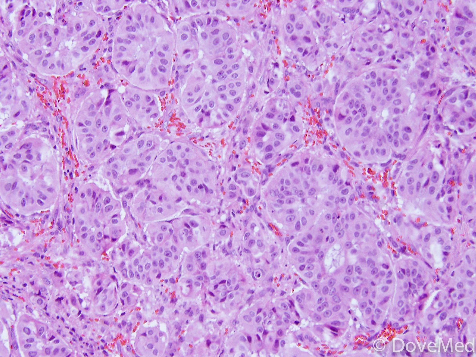 Lung Adenocarcinoma Histology