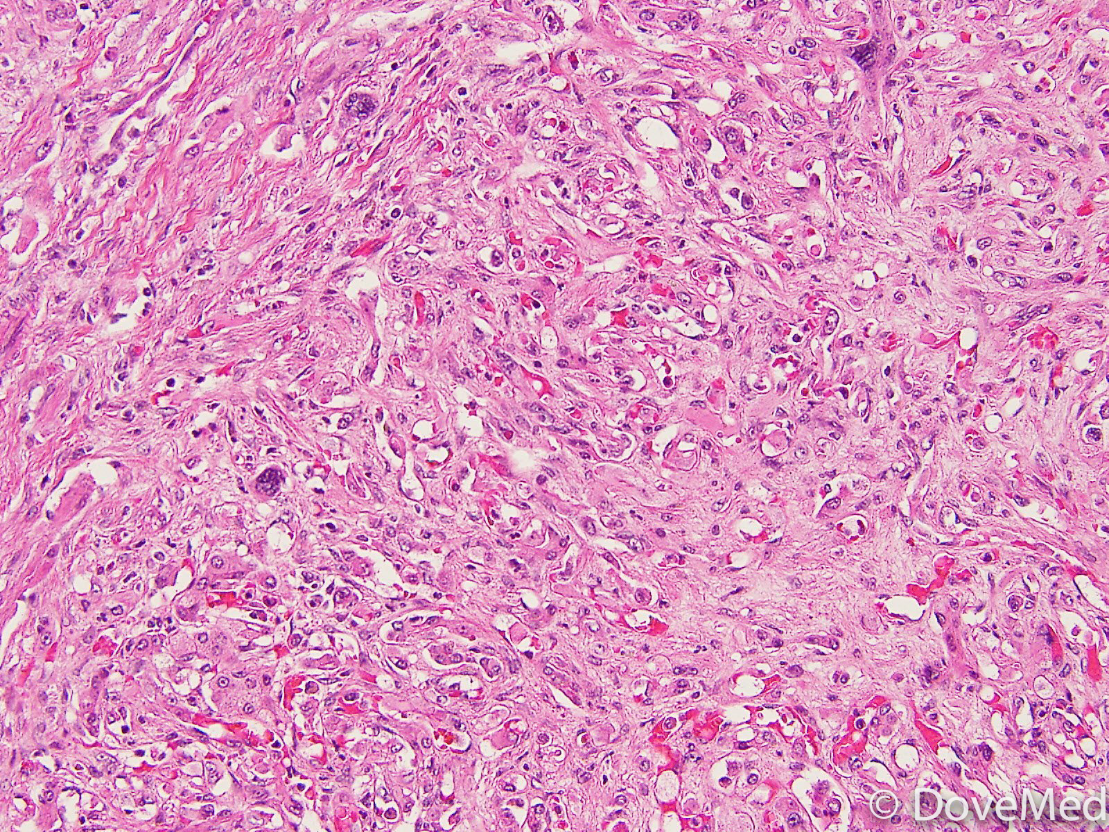 Angiosarcoma of Uterine Cervix