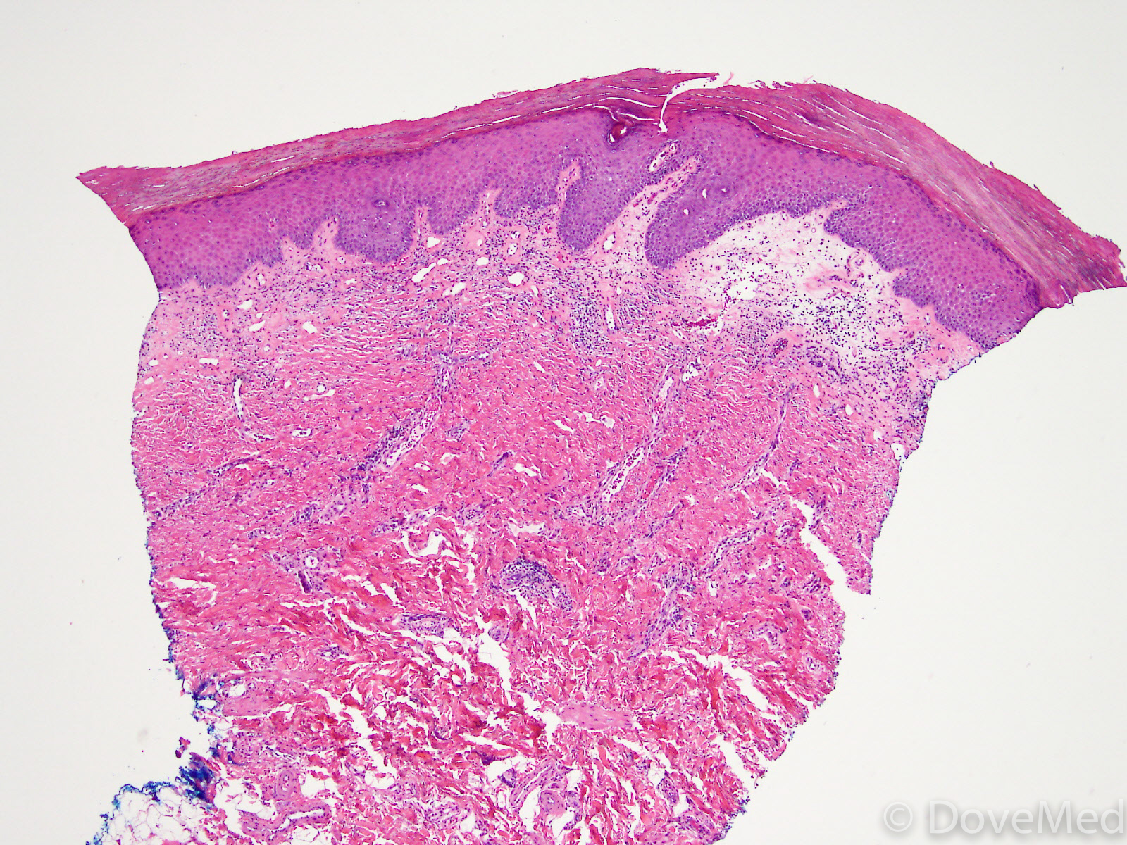 Lichen Sclerosus Of Vulva