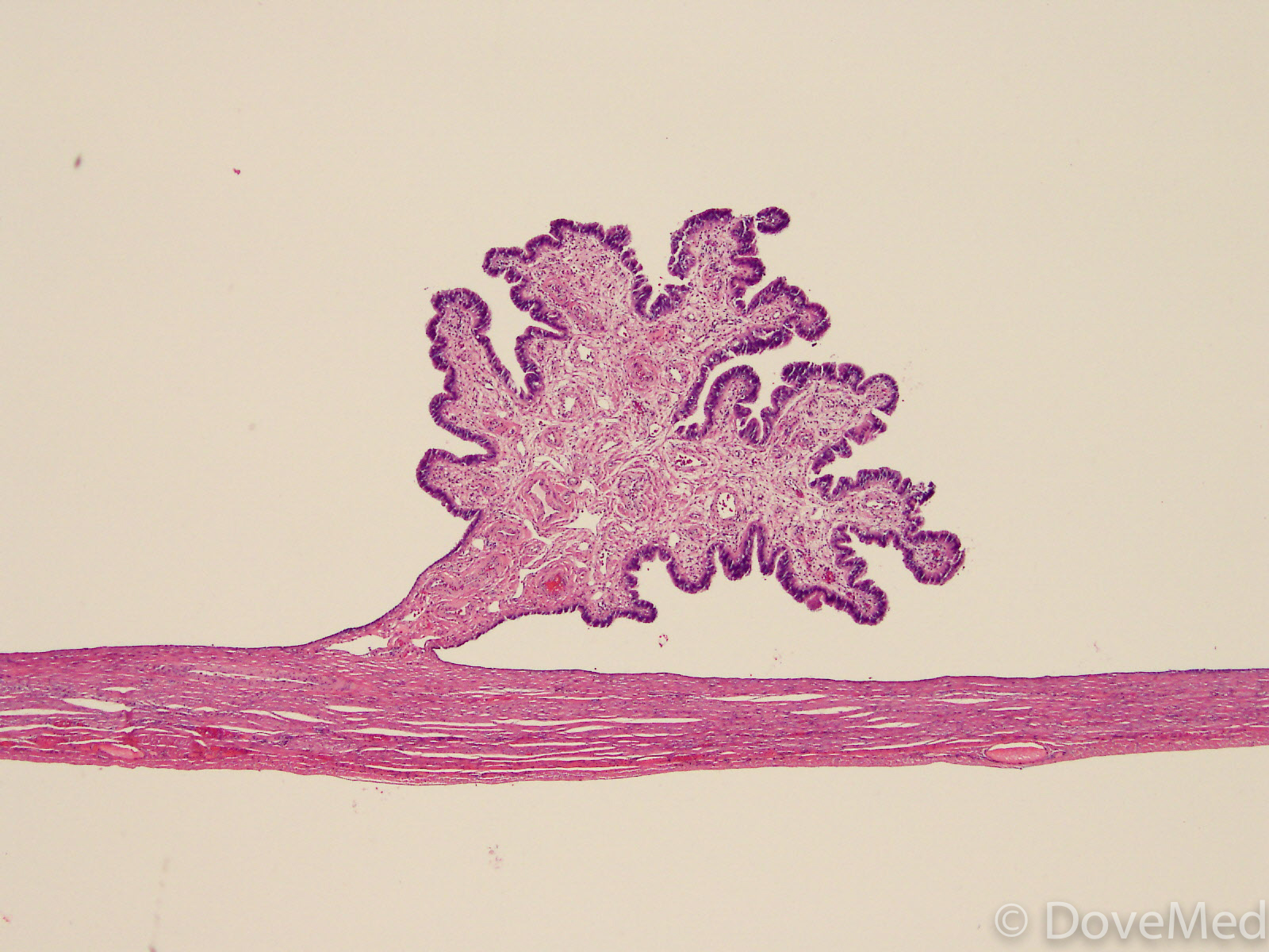 serous-papillary-cystadenoma-of-ovary