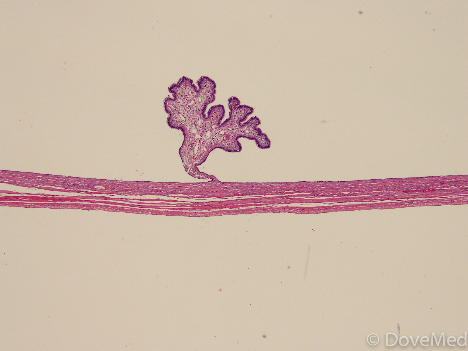 icd 10 code for benign serous cystadenofibroma
