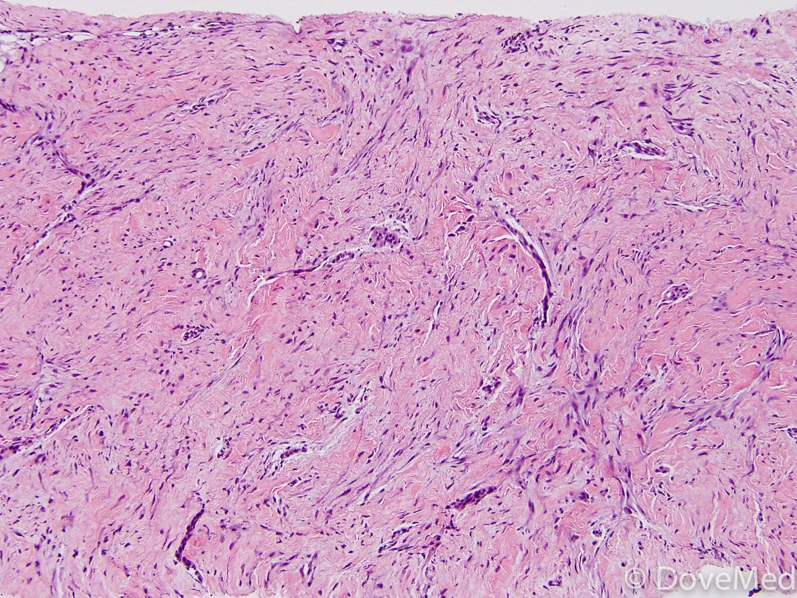 Pseudoangiomatous Stromal Hyperplasia of Breast