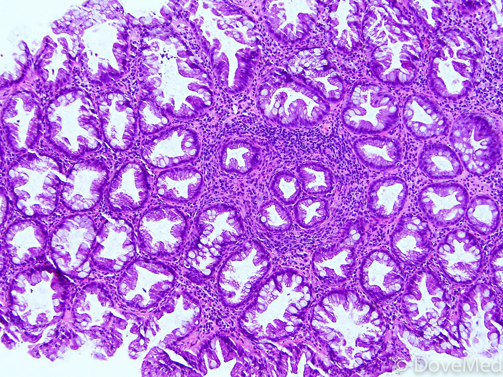 hyperplastic-polyps-of-the-colon