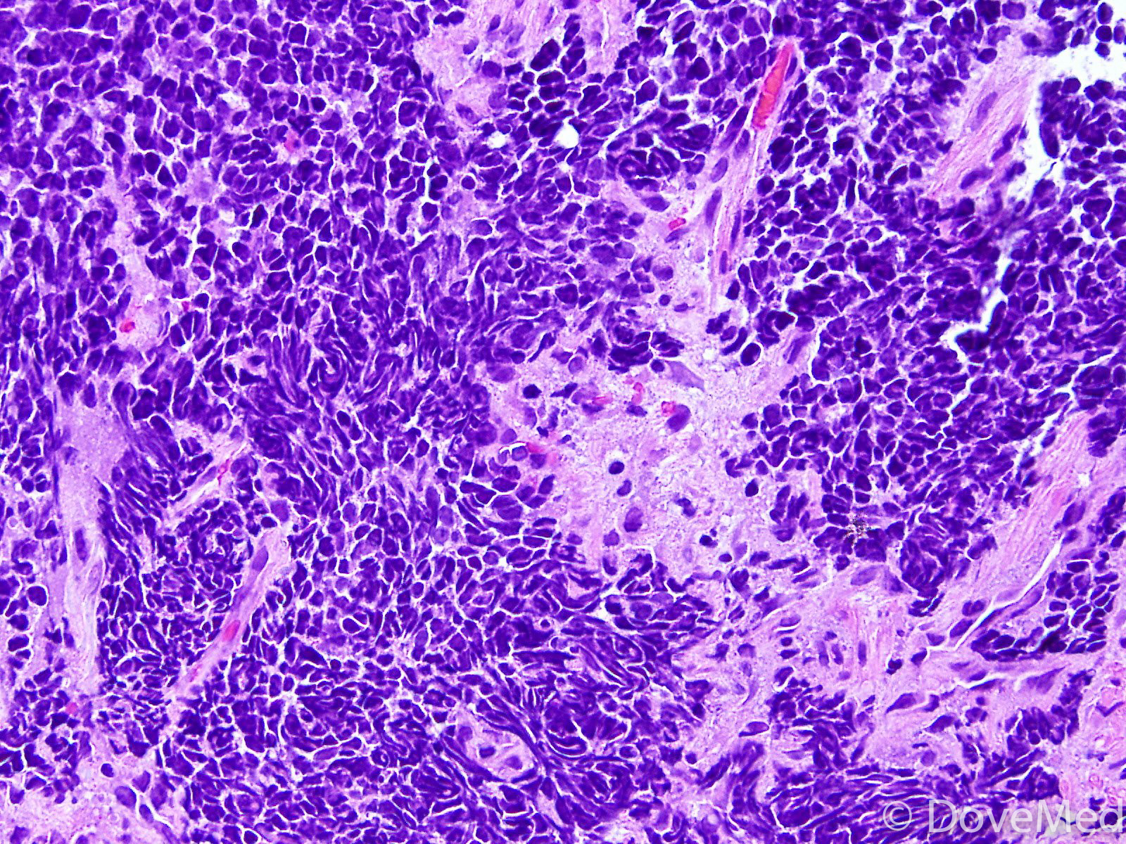 Small Cell Carcinoma of Bartholin Gland