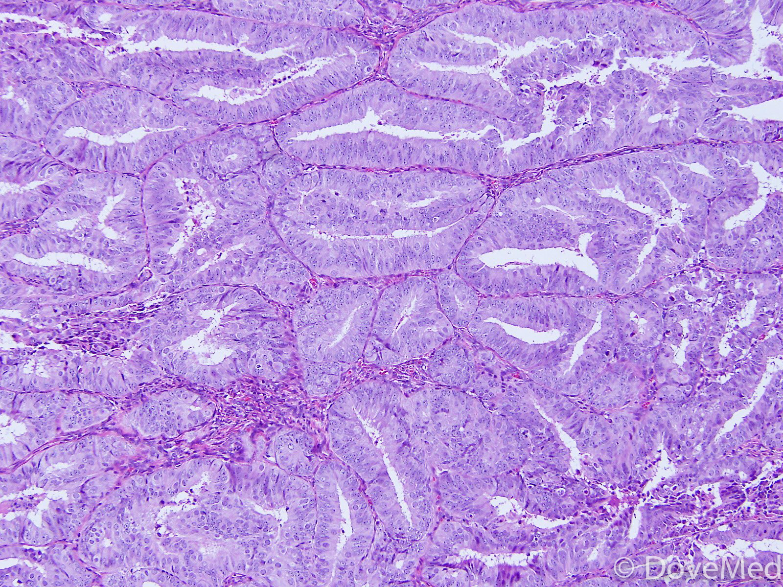 Lepidic Adenocarcinoma of Lung