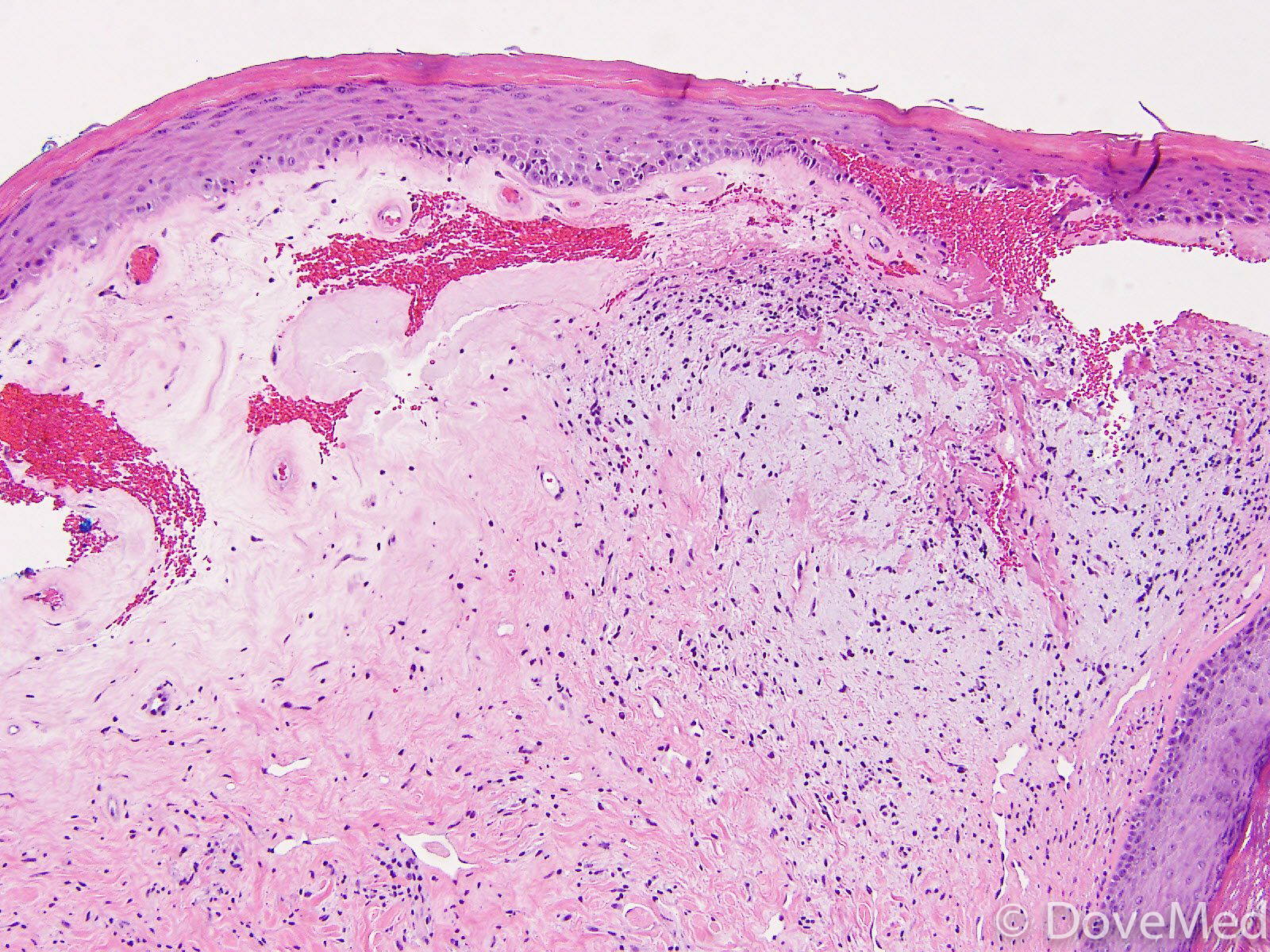 Lichen Sclerosis Histology