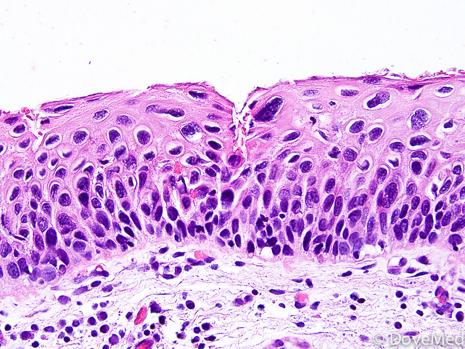 Squamous Cell Carcinoma In Situ Of Penis 