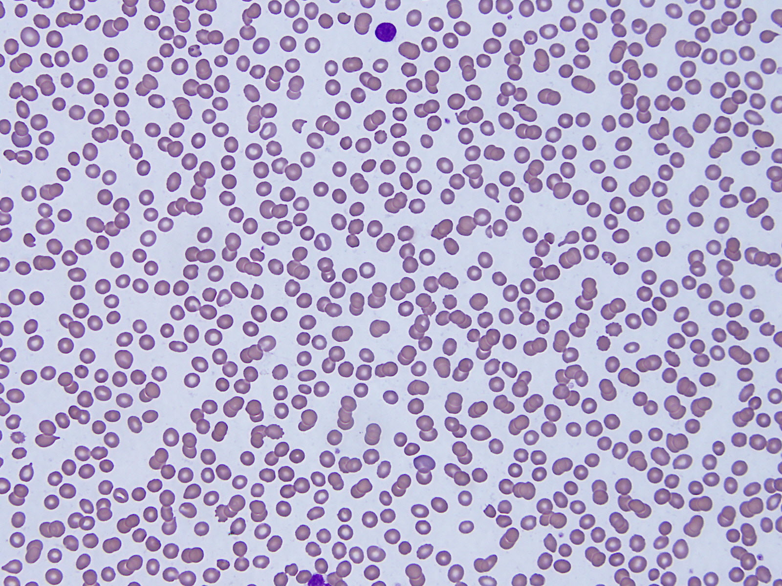 Hemoglobin Variants Blood Tests   PB170829 7IGnMx6.JPG