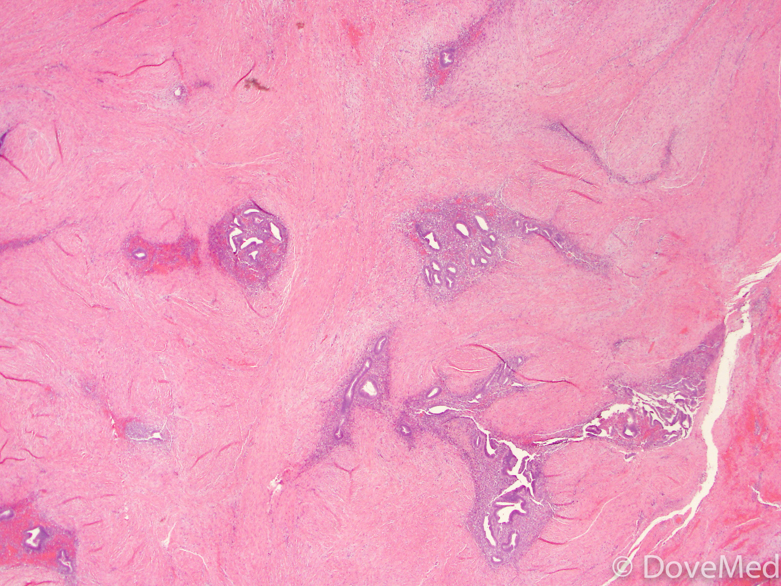 endometriosis-of-uterosacral-ligaments