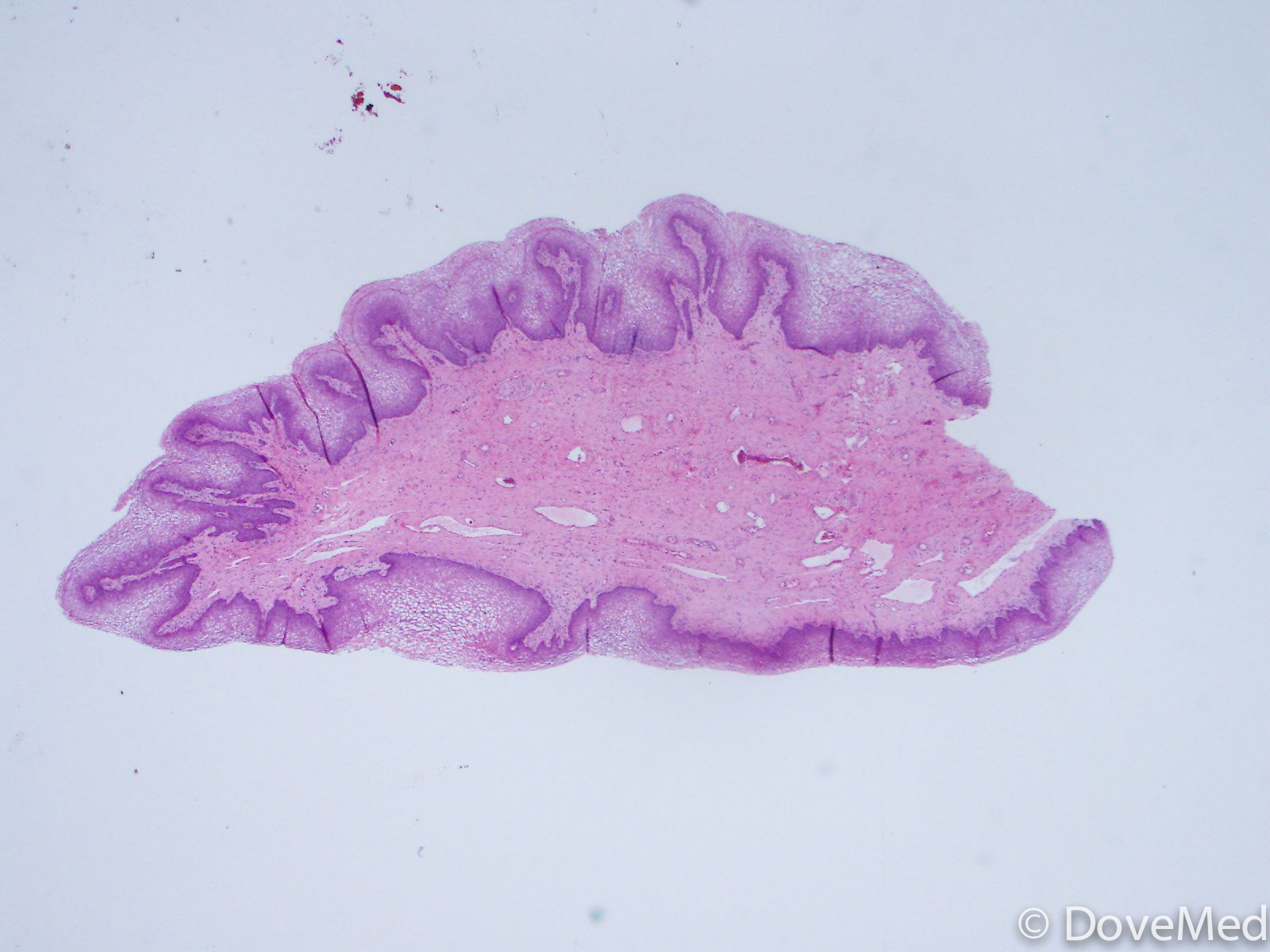 fibroepithelial polyp histology