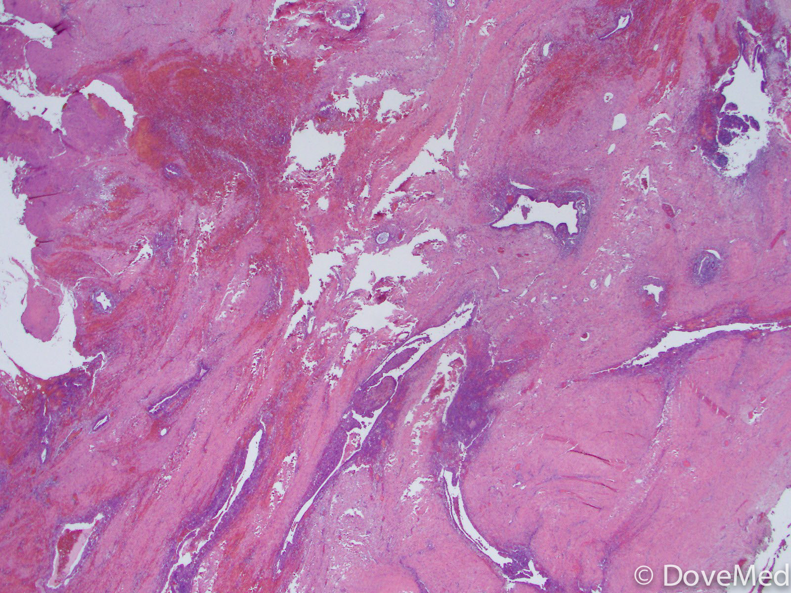 Endometriosis of the Uterine Cervix