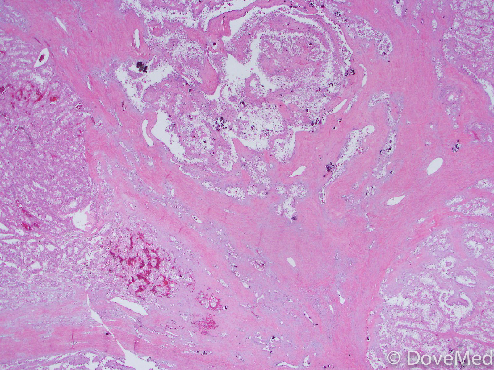 Papillary Renal Cell Carcinoma