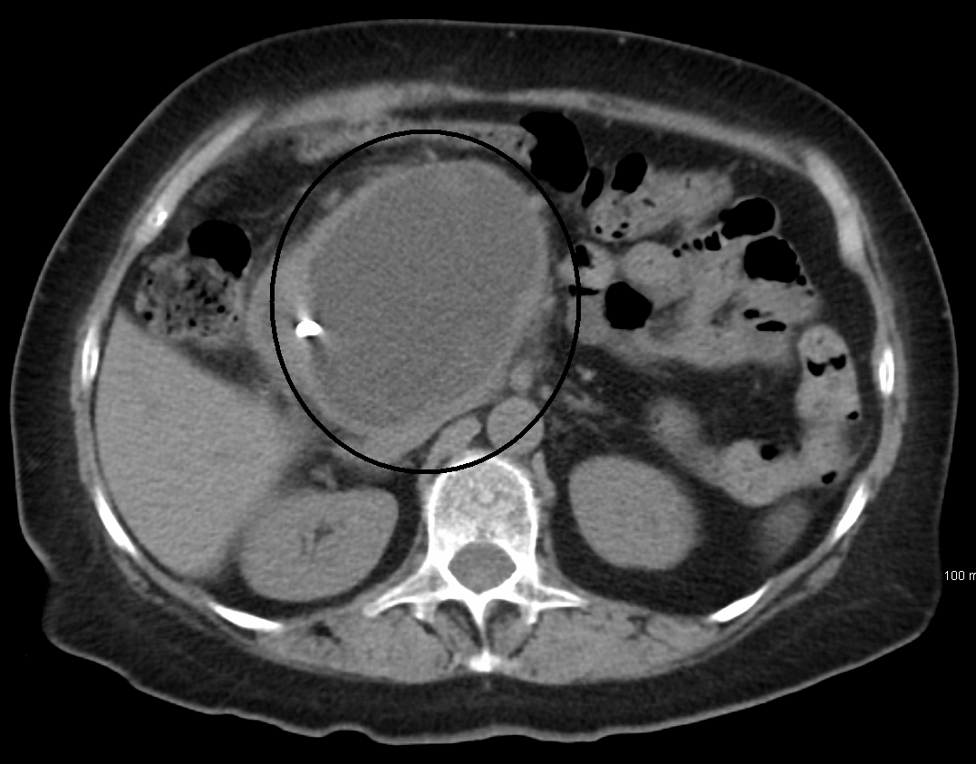 pancreatic-pseudocyst