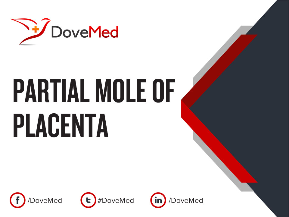 Partial Mole of Placenta