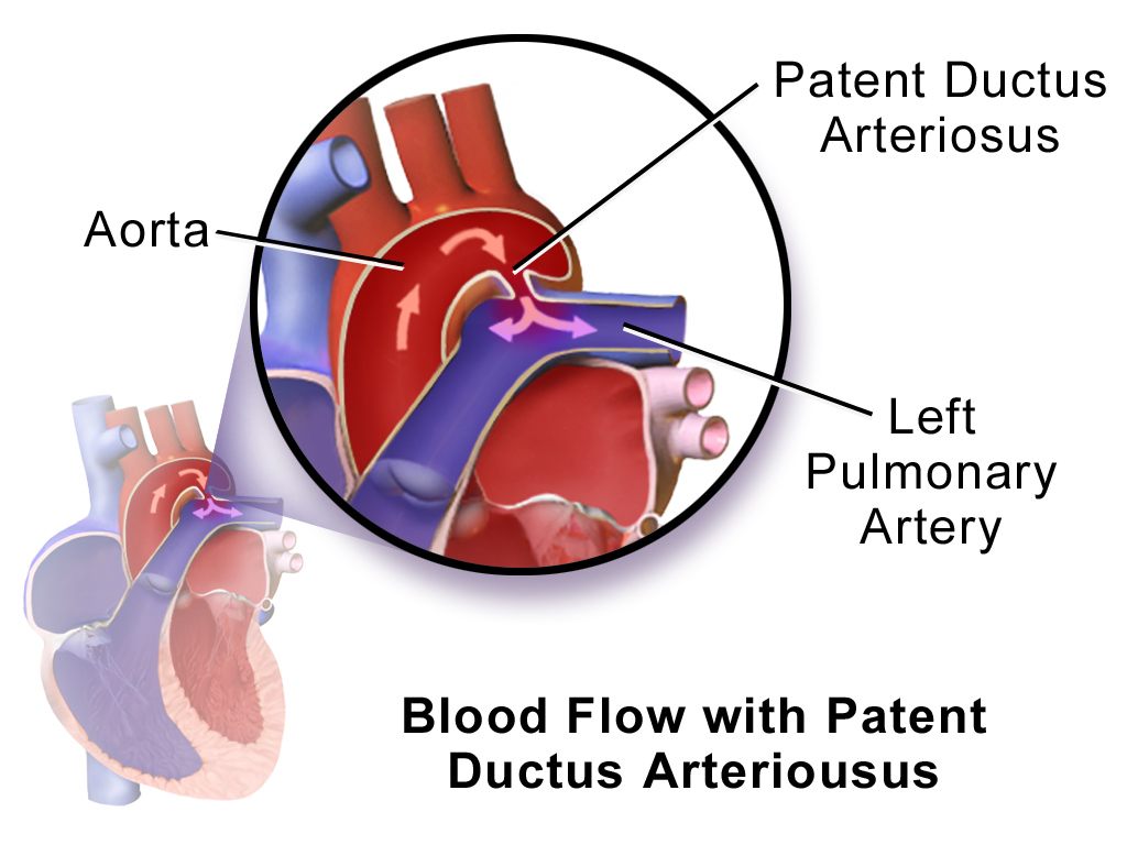 Patent Ductus Arteriosus (PDA)