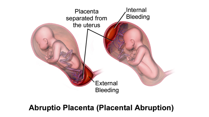 placenta-abruptio