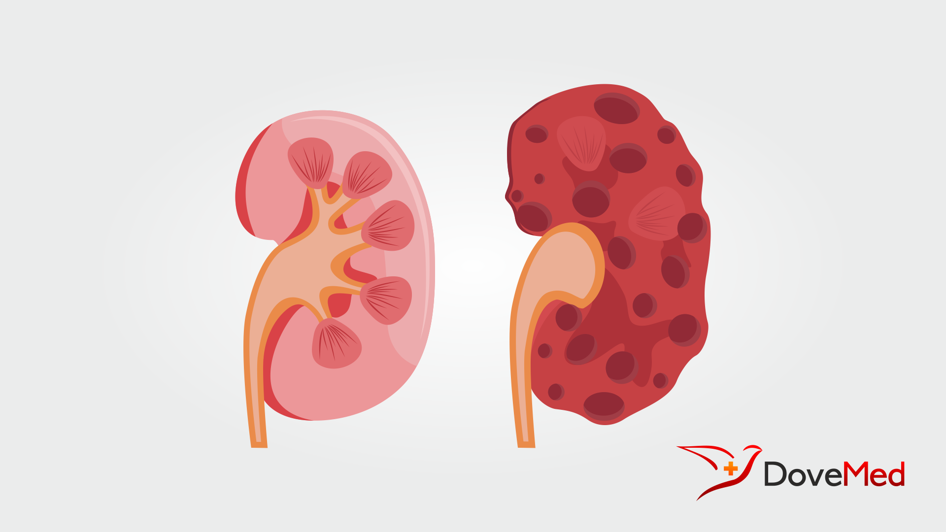 polycystic-kidney-disease