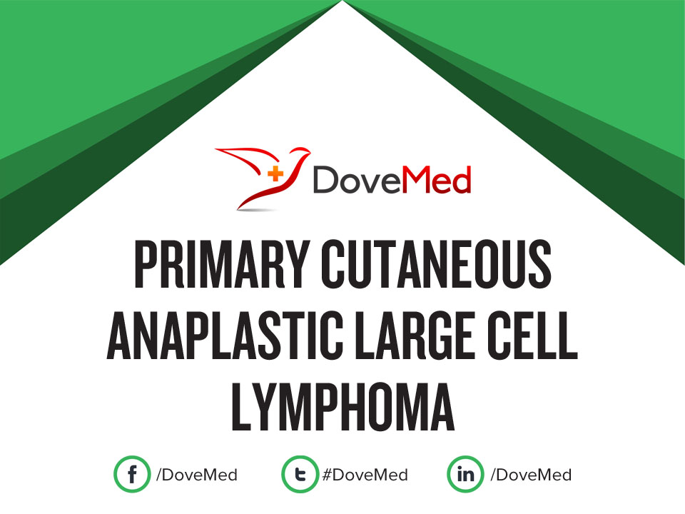 Top Anaplastic Large Cell Lymphoma Treatment