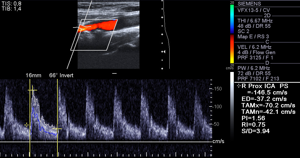 carotid doppler ultrasound normal values