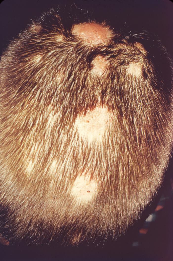 Ringworm, Scalp (Tinea Capitis) Condition, Treatments and Pictures