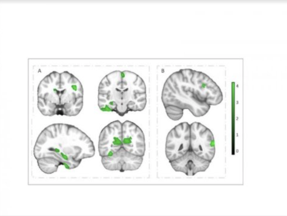 Has more brains. Тест на развитие мозга. Gray matter Volume meaning.