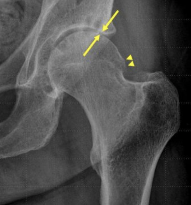 Hip Steroid Injections Associated With Risky Bone Changes