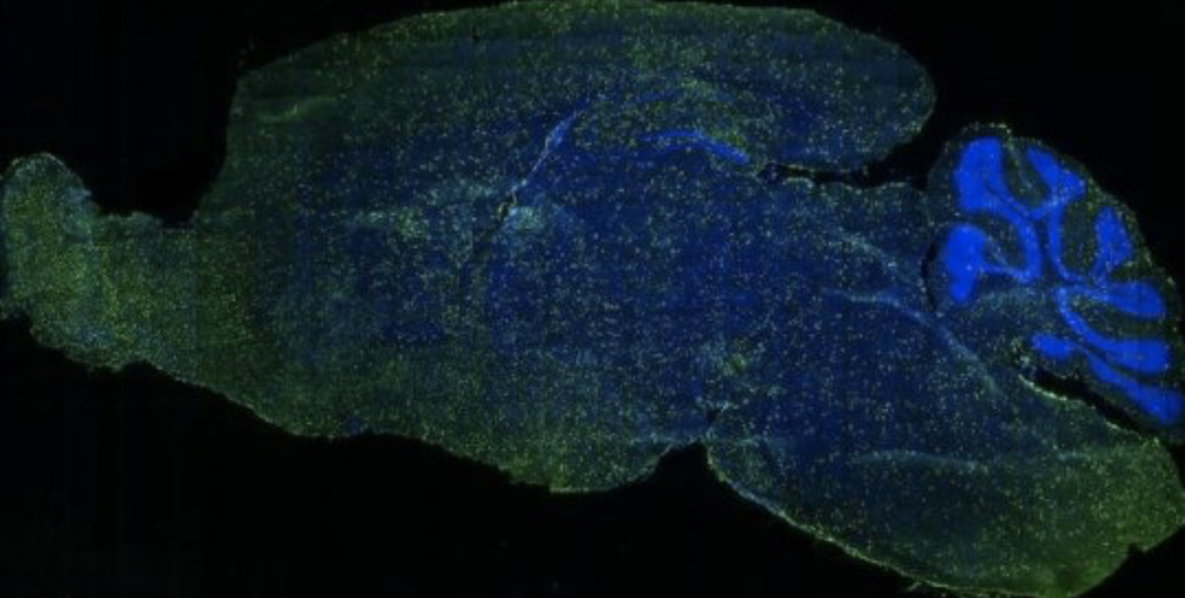 Routing Gene Therapy Directly Into Brain