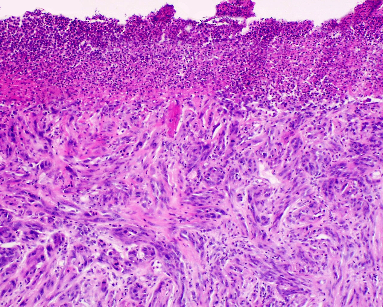 Desmoplastic Melanoma of Skin
