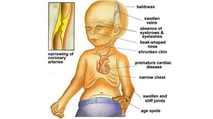 progeria chromosome