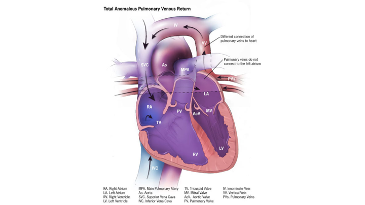 Total Anomalous Pulmonary Venous Return