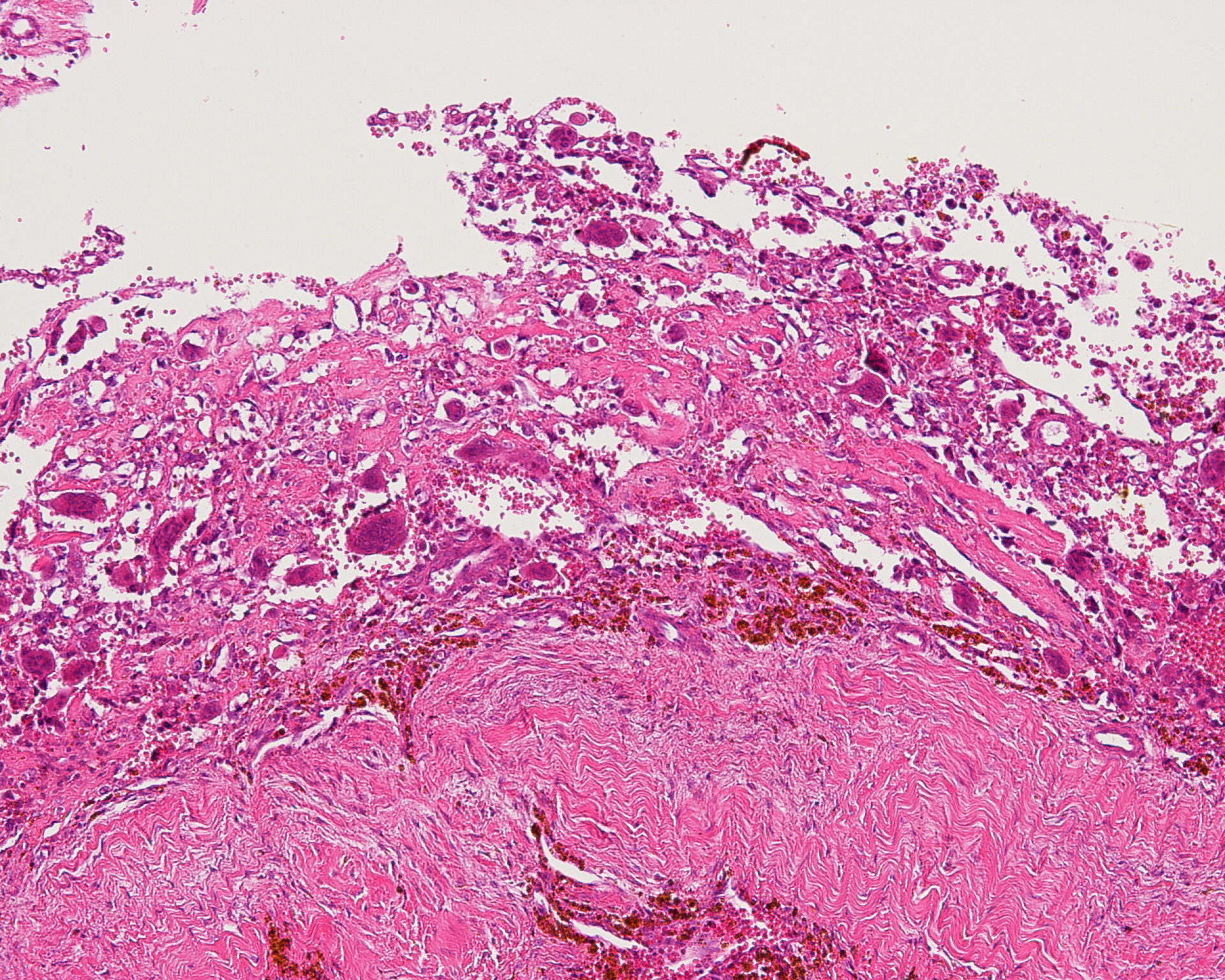 Telangiectatic Osteosarcoma