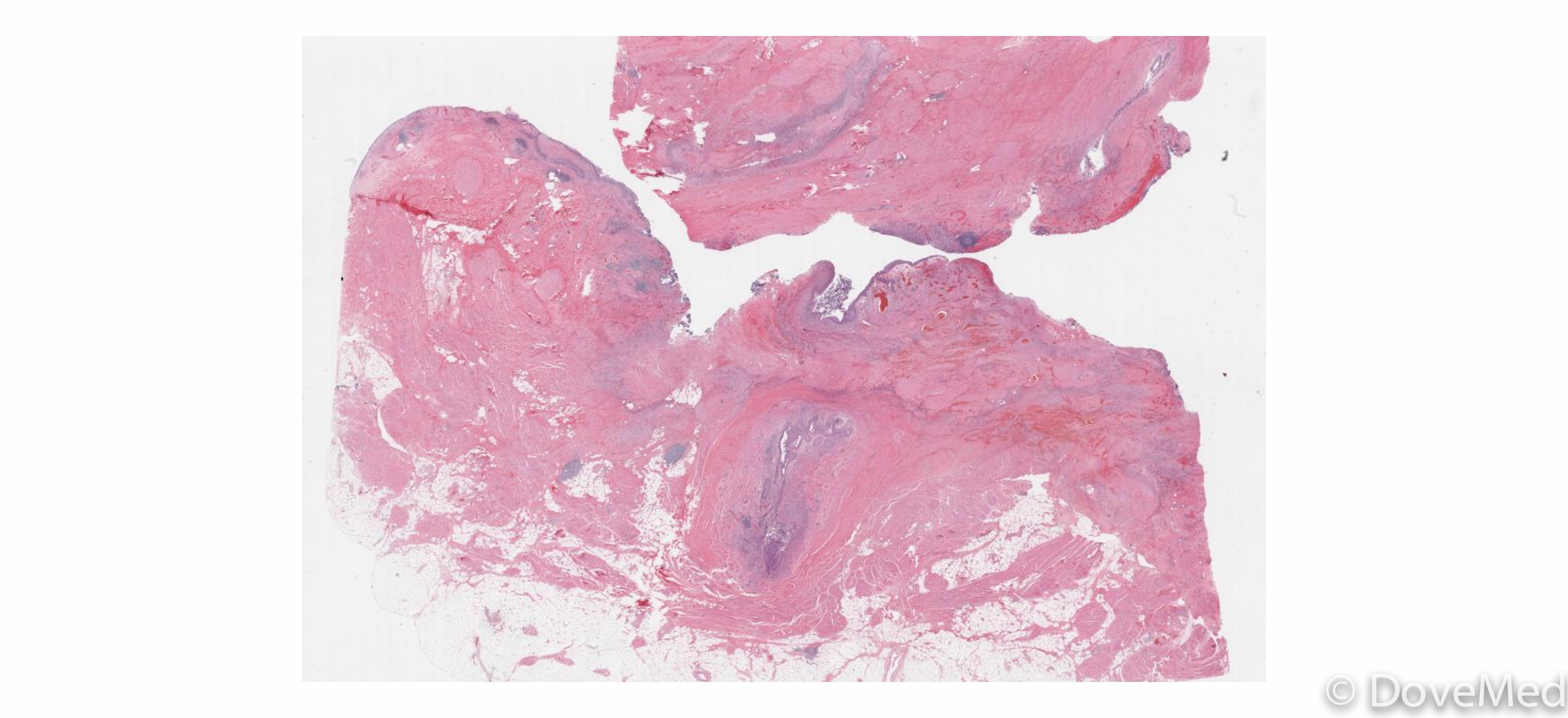 Urothelial Carcinoma In Situ