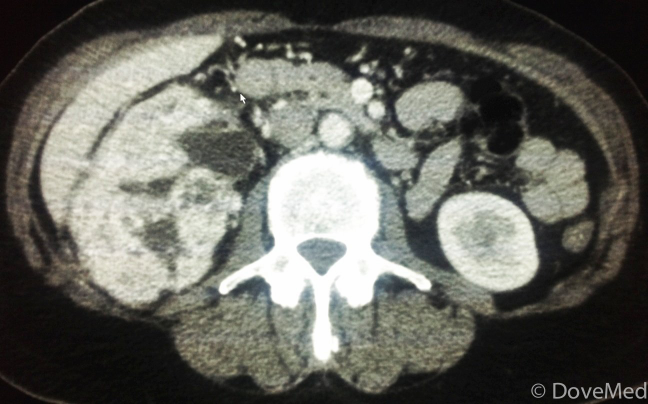 Radiofrequency Ablation of Kidney Tumor