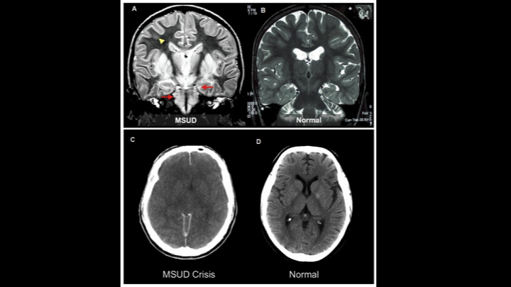 maple syrup urine disease symptoms in newborn