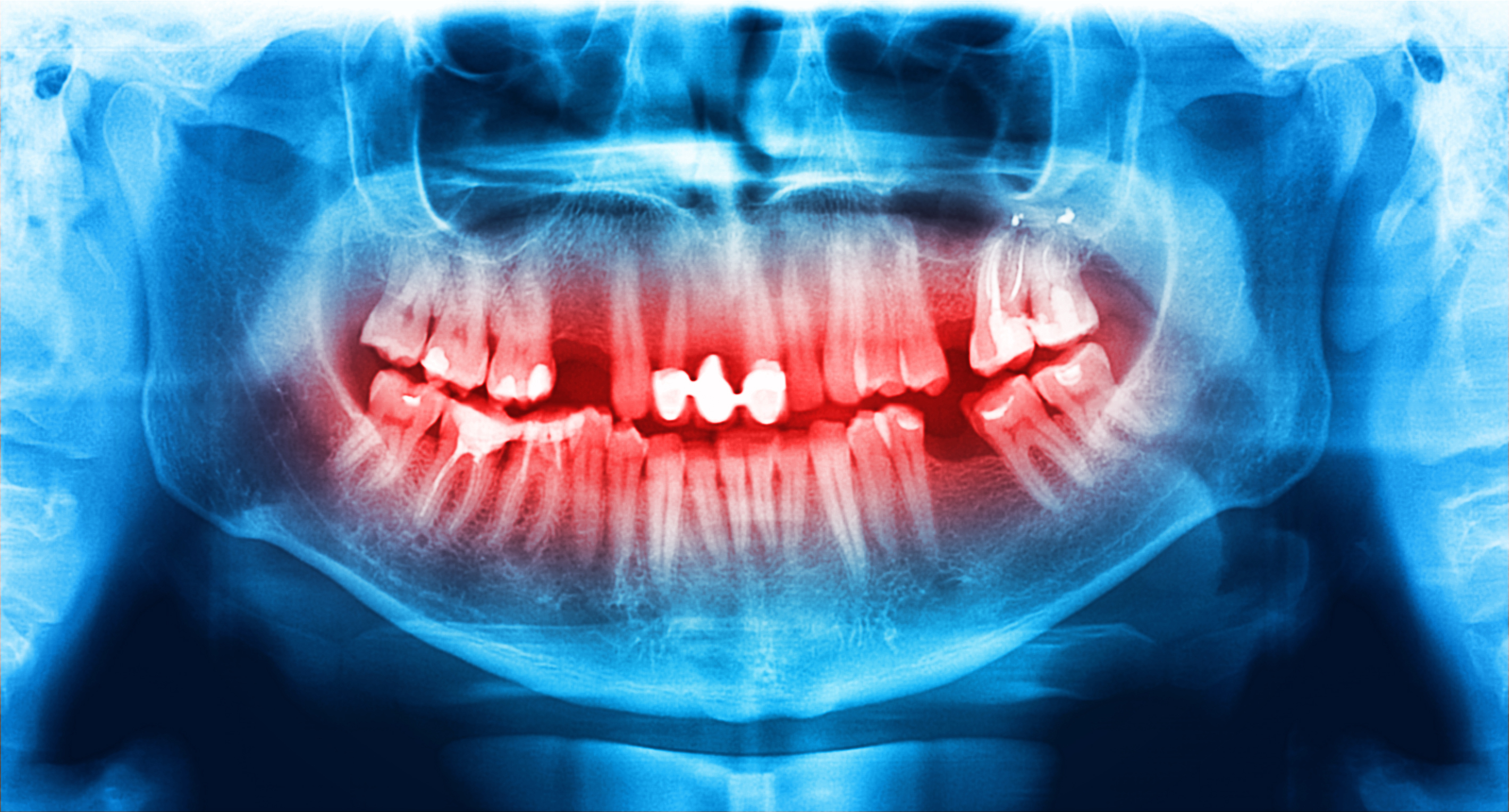 Снимок зубов нижней челюсти