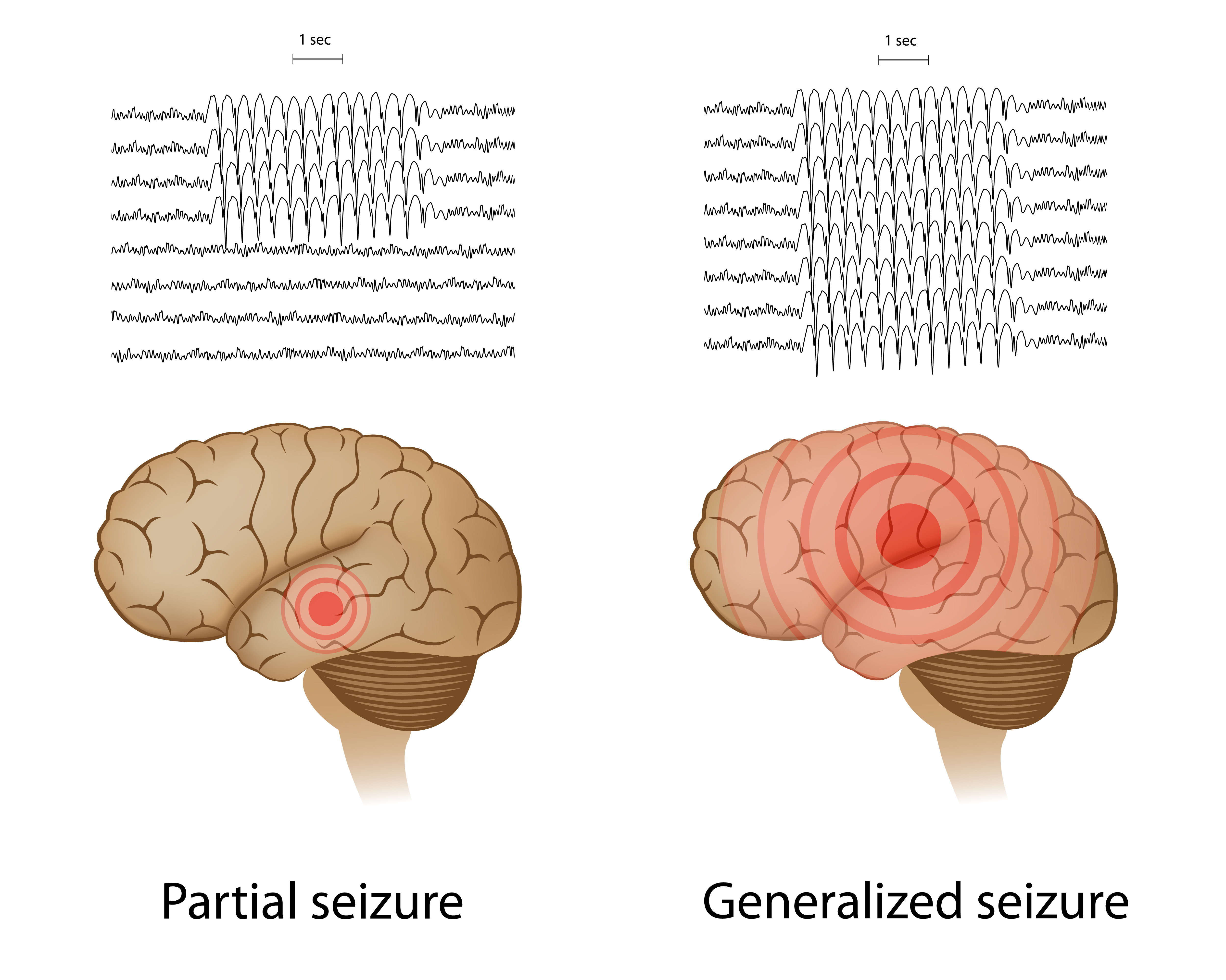 Фокальные припадки. Фокальная и генерализованная эпилепсия. Парциальные и генерализованные припадки. Парциальные и генерализованные эпилептические припадки. Парциальная эпилепсия.