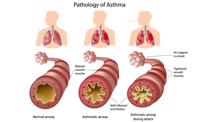 Asthma Adults