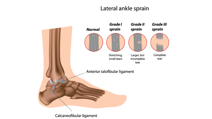 Ankle Sprain