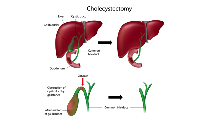 Gallbladder Removal by Laparoscopy (Laparoscopic Cholecystectomy)